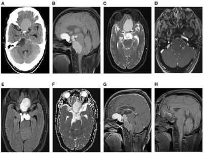 Craniopharyngioma involving the anterior, middle, and posterior cranial fossa in adults: A case report